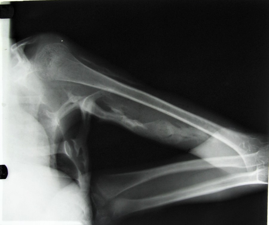 Fig.3 Right Upper arm 